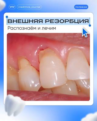 Резорбция зуба — сохраняем пульпу. Клинический случай.